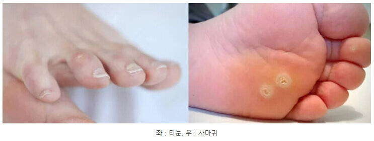 티눈 생기는 이유와 초기 증상 및 치료, 셀프 뽑기 제거, 병원 유무, 사마귀 차이점, 제거 안하면? : 발바닥, 발가락, 손가락, 손바닥 2 티눈 사마귀 차이점