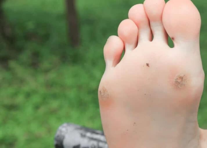 티눈 생기는 이유와 초기 증상 및 치료, 셀프 뽑기 제거, 병원 유무, 사마귀 차이점, 제거 안하면? : 발바닥, 발가락, 손가락, 손바닥 3 발바닥 티눈