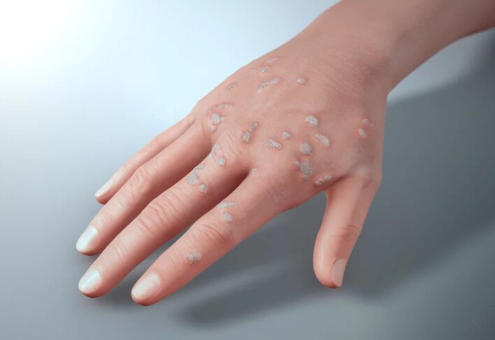 인유두종바이러스(hpv) 증상 및 원인, 잠복기, 검사, 비용, 치료, 백신, 자연 소멸 : 남자 접종 유무 1 hpv 감염자의 손